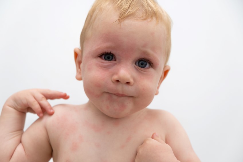 Αλλεργικό σοκ σε παιδιά: Αντιμετώπιση, συμπτώματα και αιτίες